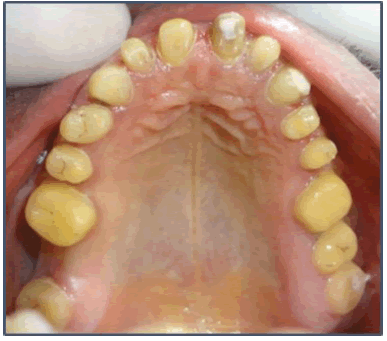 Ijmrhs-maxillary